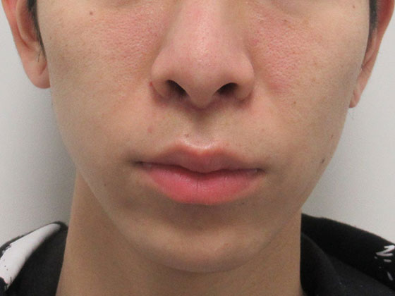 症例写真 ダウンタイム 男性にも人中短縮はおすすめです Taクリニック 美容整形 美容外科 新宿 銀座 横浜 大阪 福岡 川越 高崎 Taクリニック 美容整形 美容外科