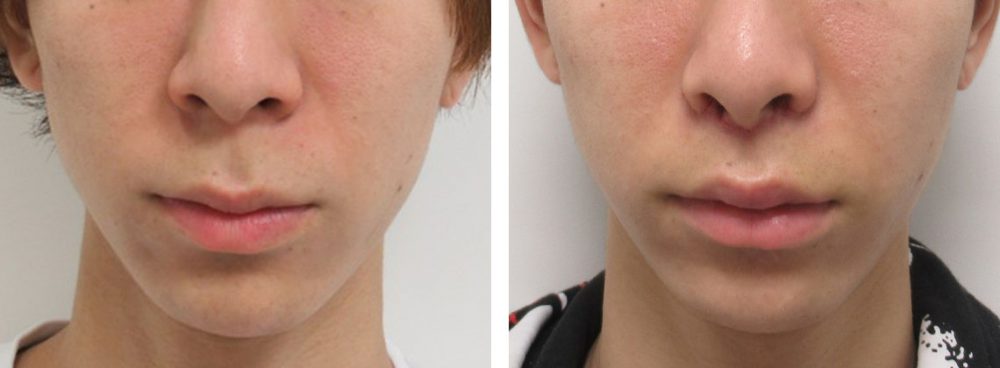 人中短縮術(リップリフト)・外側人中短縮術/TAC式 鼻翼縮小術(小鼻縮小)の症例写真 施術前後 1週間