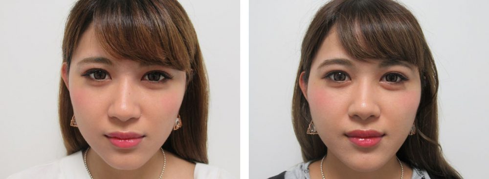 TAC式ツヤ肌コラーゲンリフトの全顔モニター様