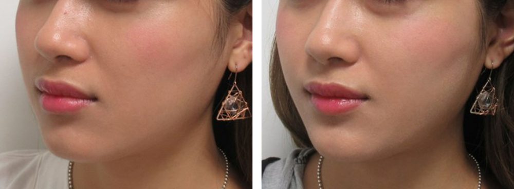 TAC式 ツヤ肌コラーゲンリフト®/ボトックス注射：その他の症例写真 施術前後 ２週間