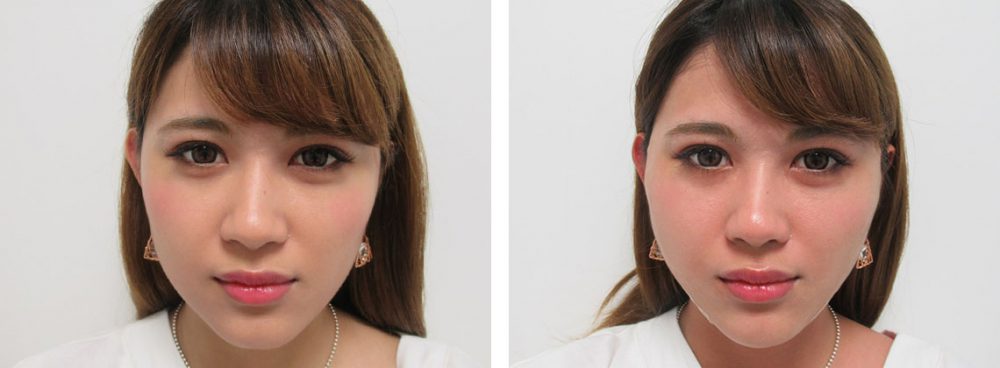 TAC式 ツヤ肌コラーゲンリフト®/ボトックス注射：その他の症例写真 施術前後 直後