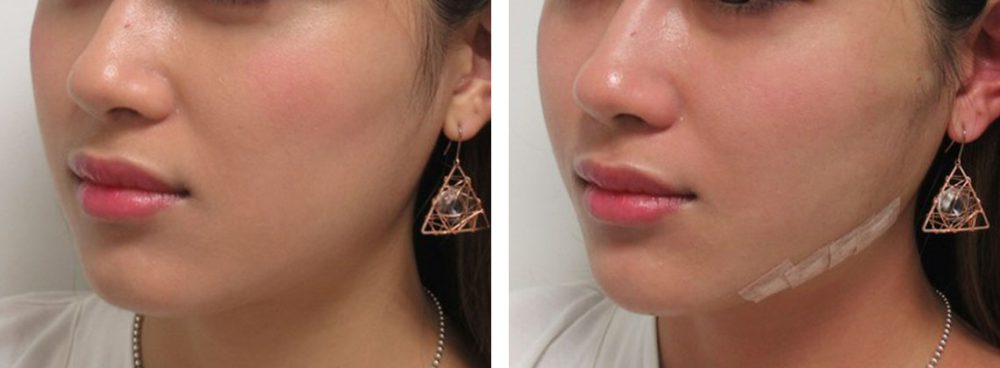 TAC式 ツヤ肌コラーゲンリフト®/ボトックス注射：その他の症例写真 施術前後 直後