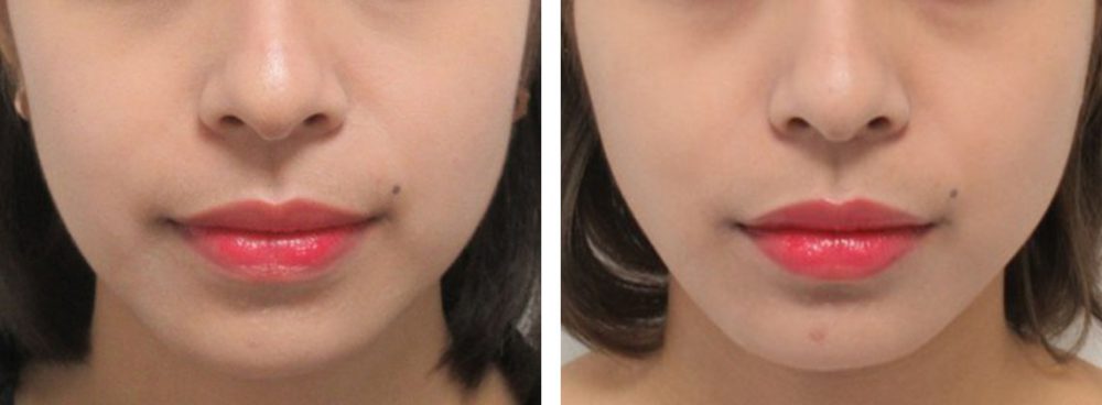 ナチュラルな仕上がりのツヤ肌コラーゲンリフト