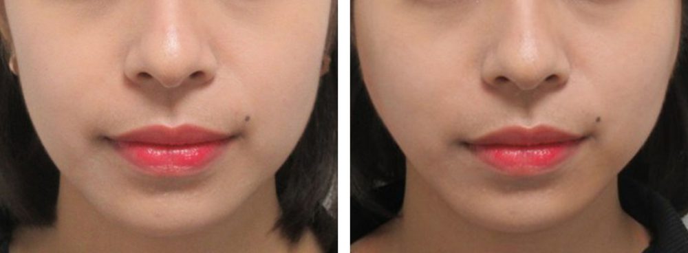 TAC式 ツヤ肌コラーゲンリフト®/ボトックス注射：その他の症例写真 施術前後 直後