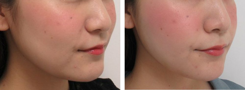 TAC式 ツヤ肌コラーゲンリフト®/ボトックス注射：その他の症例写真 施術前後 １０日