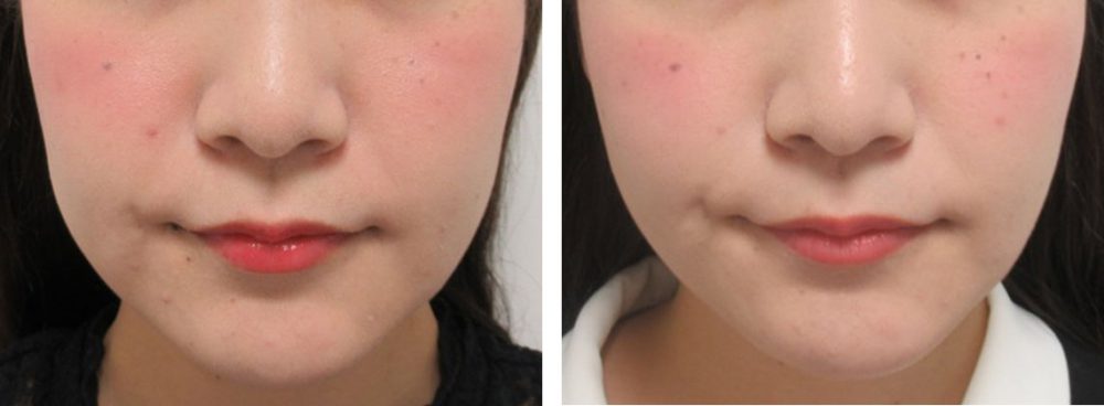 糸リフトでどの角度から見てもスッキリとしたフェイスラインに