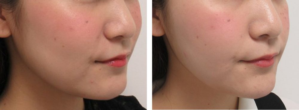 TAC式 ツヤ肌コラーゲンリフト®/ボトックス注射：その他の症例写真 施術前後 １ヵ月