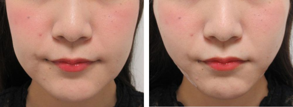 TAC式 ツヤ肌コラーゲンリフト®/ボトックス注射：その他の症例写真 施術前後 直後