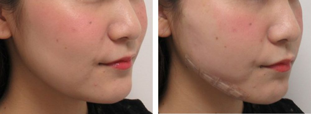 TAC式 ツヤ肌コラーゲンリフト®/ボトックス注射：その他の症例写真 施術前後 直後