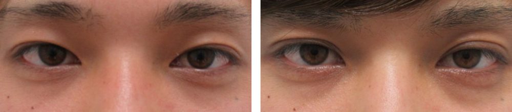 二重埋没法の症例写真 施術前後 1ヵ月