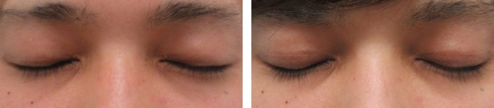 二重埋没法の症例写真 施術前後 1ヵ月