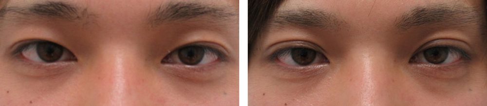 二重埋没法の症例写真 施術前後 1週間