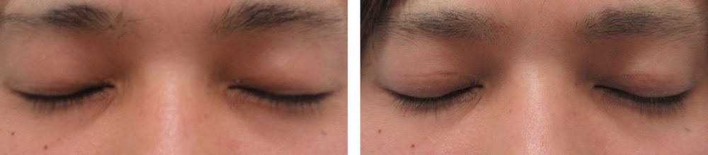 二重埋没法の症例写真 施術前後 1週間