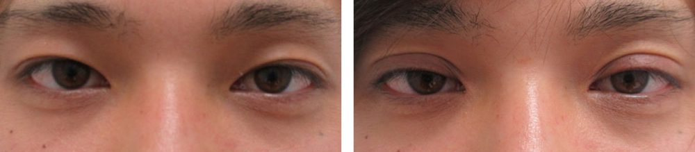 二重埋没法の症例写真 施術前後 直後