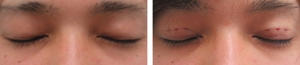 二重埋没法の症例写真 施術前後 直後