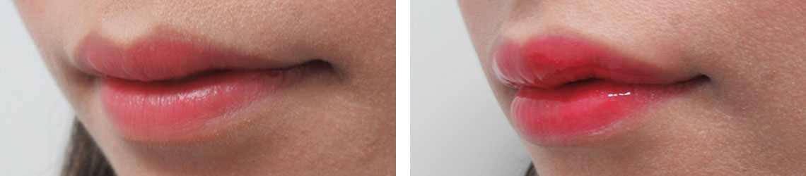 アヒル口形成で唇を自然にボリュームアップ