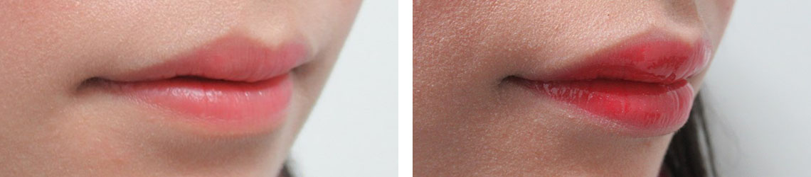 の症例写真 施術前後 １週間