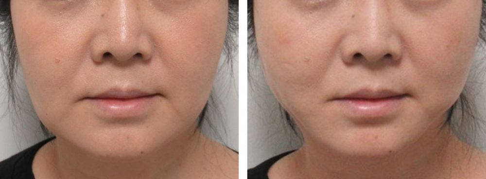 TAC式 ツヤ肌コラーゲンリフト®の症例写真 施術前後 直後