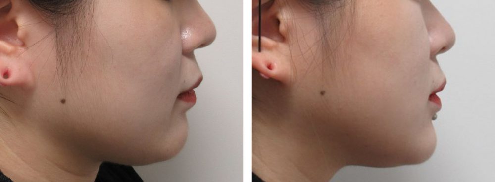 ヒアルロン酸で少しだけ顎を高くする