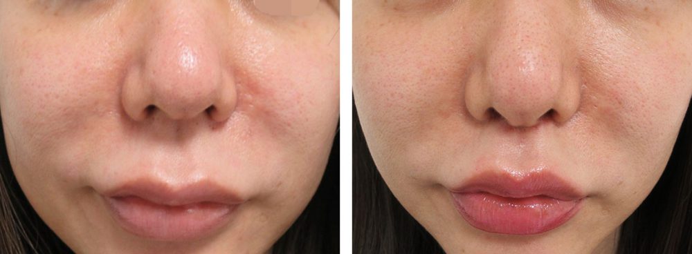 人中短縮術(リップリフト)・外側人中短縮術の症例写真 施術前後 1ヵ月