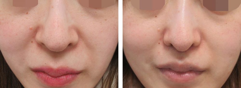 人中短縮と鼻翼縮小を組み合わせてお鼻を小さくする