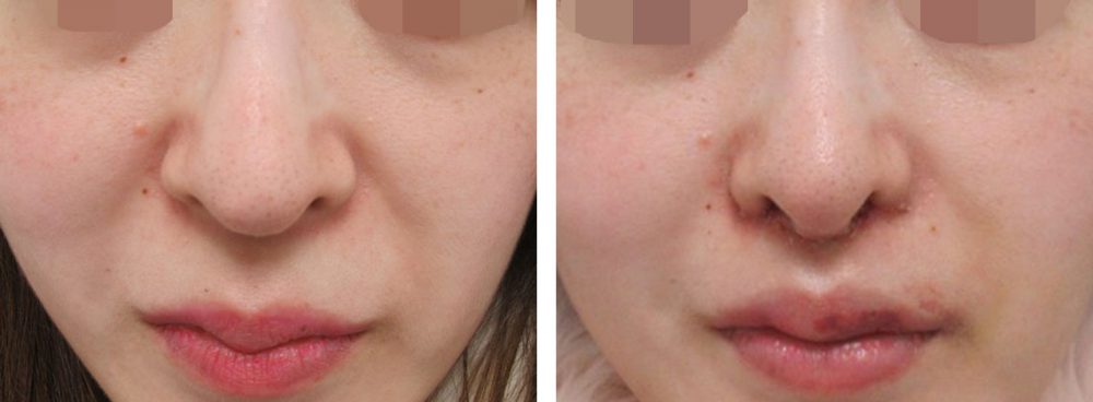 人中短縮術(リップリフト)・外側人中短縮術/TAC式 鼻翼縮小術（小鼻縮小）の症例写真 施術前後 １週間