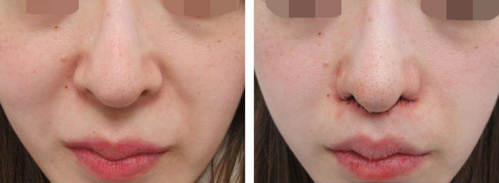 人中短縮術(リップリフト)・外側人中短縮術/TAC式 鼻翼縮小術（小鼻縮小）の症例写真 施術前後 直後