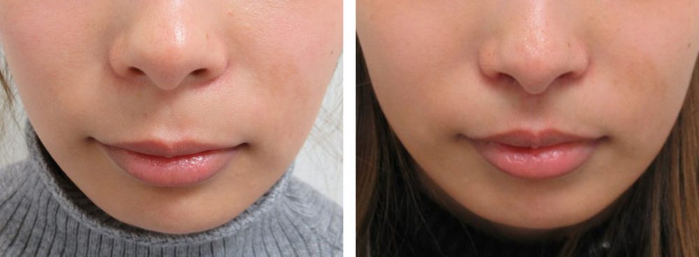 顎の長さと人中の長さのバランスは大切です