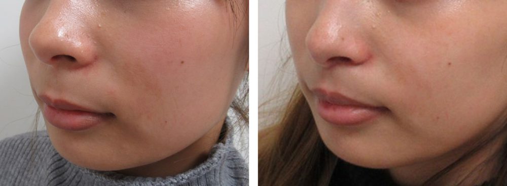 人中短縮術(リップリフト)・外側人中短縮術の症例写真 施術前後 １ヵ月