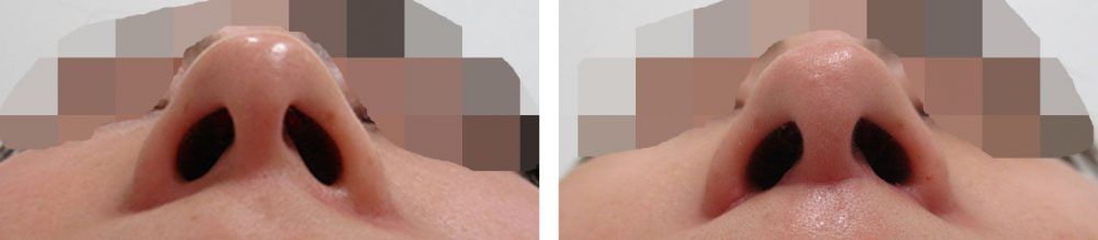 人中短縮術(リップリフト)・外側人中短縮術の症例写真 施術前後 １ヵ月