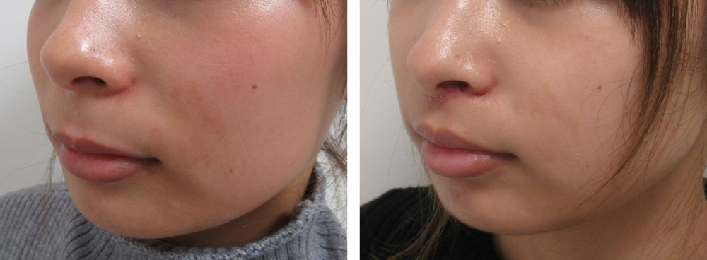 人中短縮術(リップリフト)・外側人中短縮術の症例写真 施術前後 １週間