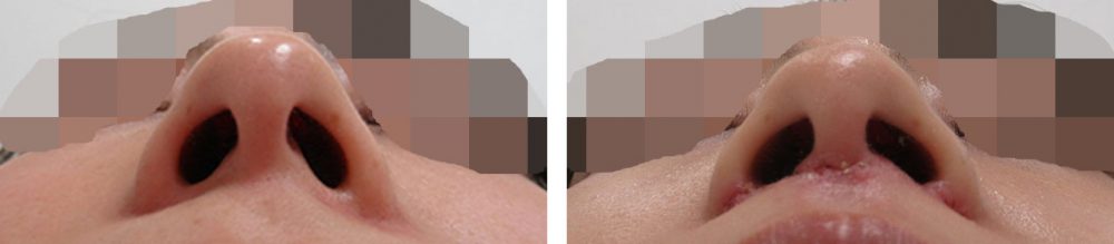 人中短縮術(リップリフト)・外側人中短縮術の症例写真 施術前後 １週間