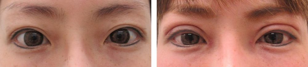 二重切開（全切開法）/目尻切開術の症例写真 施術前後 １週間