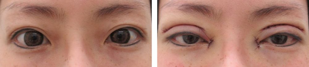 二重切開（全切開法）/目尻切開術の症例写真 施術前後 直後