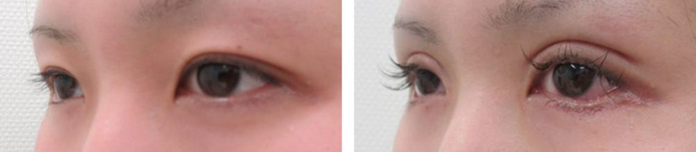 二重切開（全切開法）/目頭切開術/グラマラスライン（タレ目形成）の症例写真 施術前後 １ヵ月