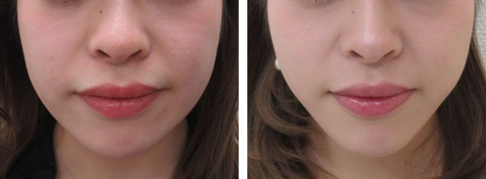 TAC式 ツヤ肌コラーゲンリフト®/顎のヒアルロン酸注射の症例写真 施術前後 1ヵ月