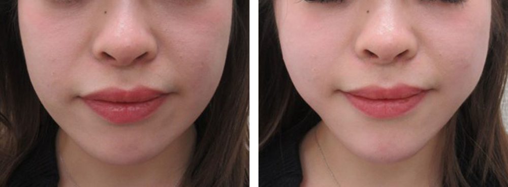 TAC式 ツヤ肌コラーゲンリフト®/顎のヒアルロン酸注射の症例写真 施術前後 直後
