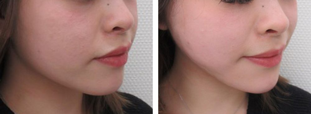 TAC式 ツヤ肌コラーゲンリフト®/顎のヒアルロン酸注射の症例写真 施術前後 直後