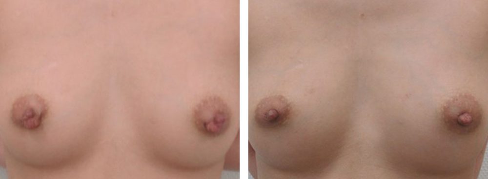 乳頭縮小術の症例写真 施術前後 1ヵ月
