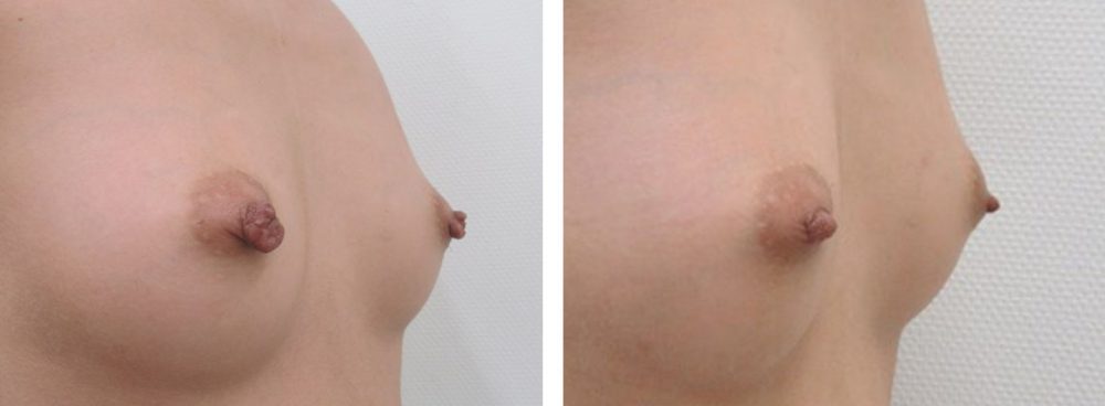 乳頭縮小術の症例写真 施術前後 1ヵ月