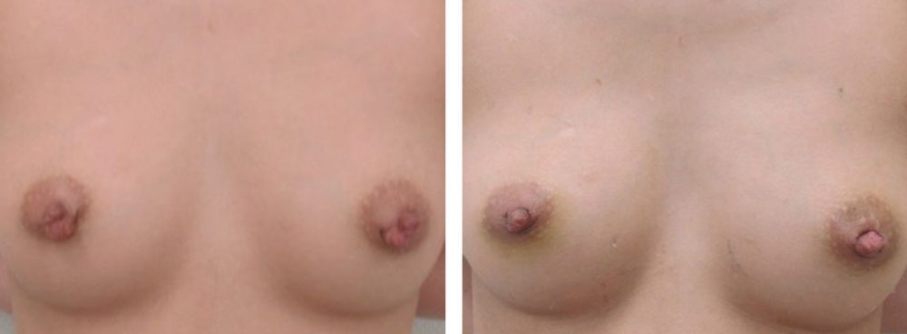 乳頭縮小術の症例写真 施術前後 1週間