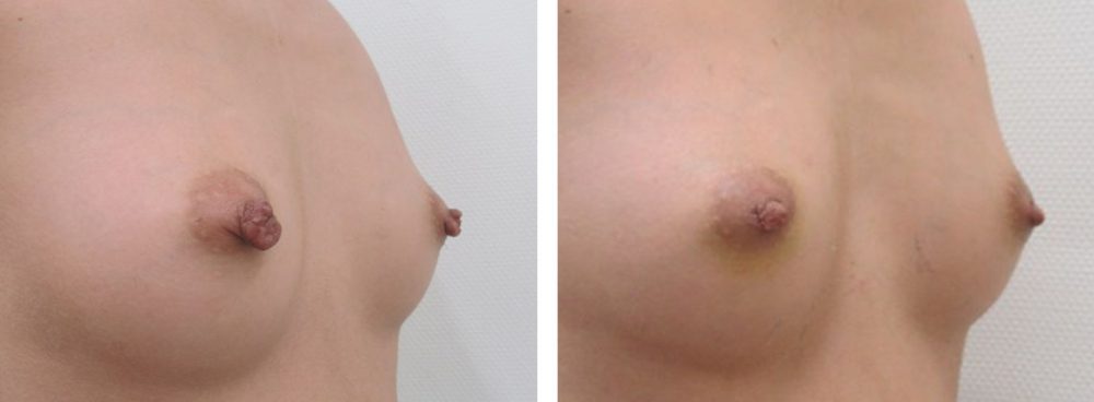 乳頭縮小術の症例写真 施術前後 1週間