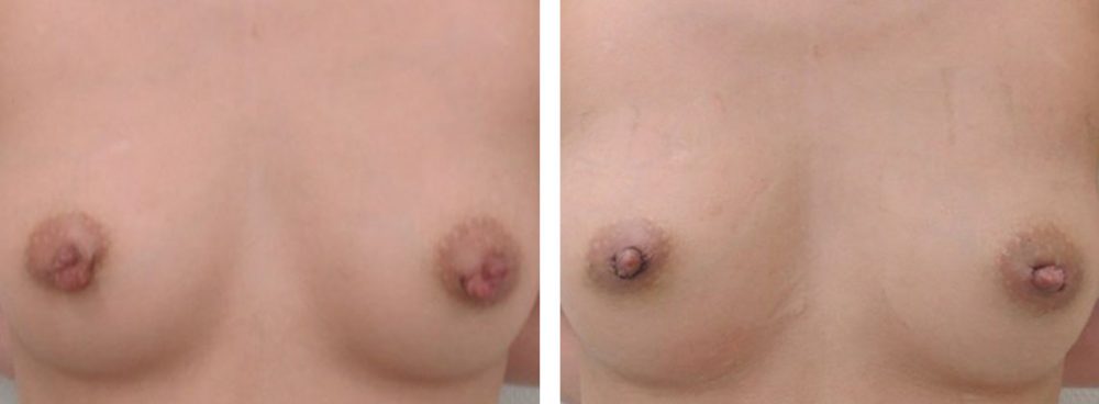 乳頭縮小術の症例写真 施術前後 3日