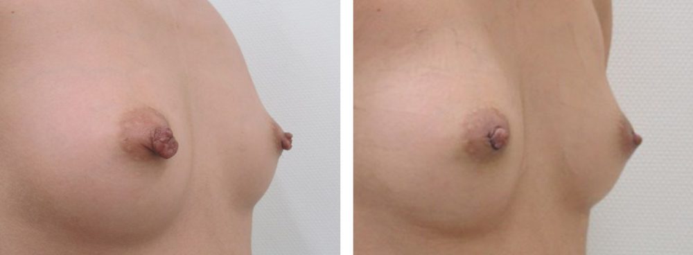 乳頭縮小術の症例写真 施術前後 3日
