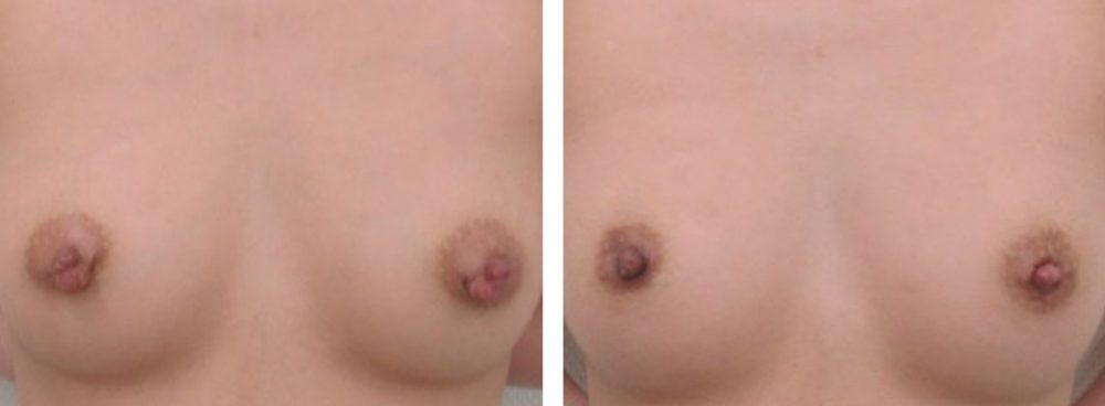 乳頭縮小術の症例写真 施術前後 直後