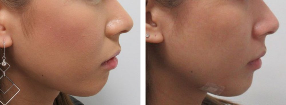 顎にヒアルロン酸を注入して横顔を整える