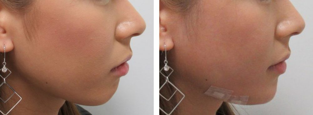 ヒアルロン酸注射：その他/TAC式 ツヤ肌コラーゲンリフト®の症例写真 施術前後 