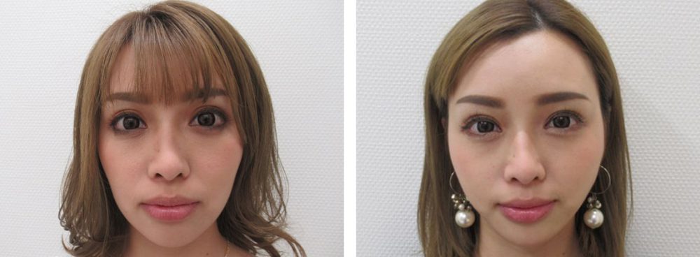 TAC式 ツヤ肌コラーゲンリフト®の症例写真 施術前後 １週間