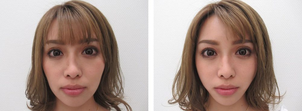 TAC式 ツヤ肌コラーゲンリフト®の症例写真 施術前後 直後