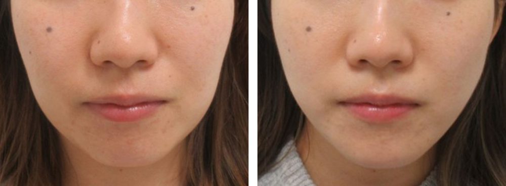 TAC式リフトとヒアルロン酸で輪郭の改善